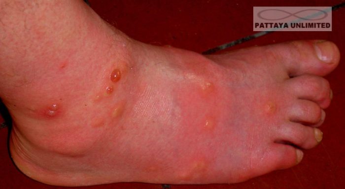 Allergenic reaction to mosquito bites on ankle and foot